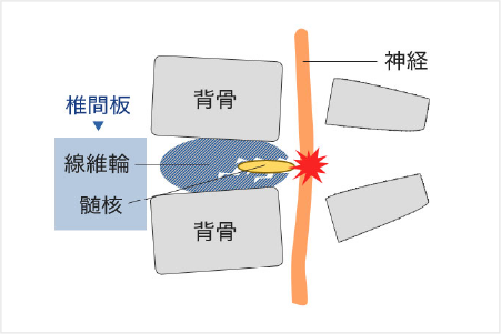 神経の障害